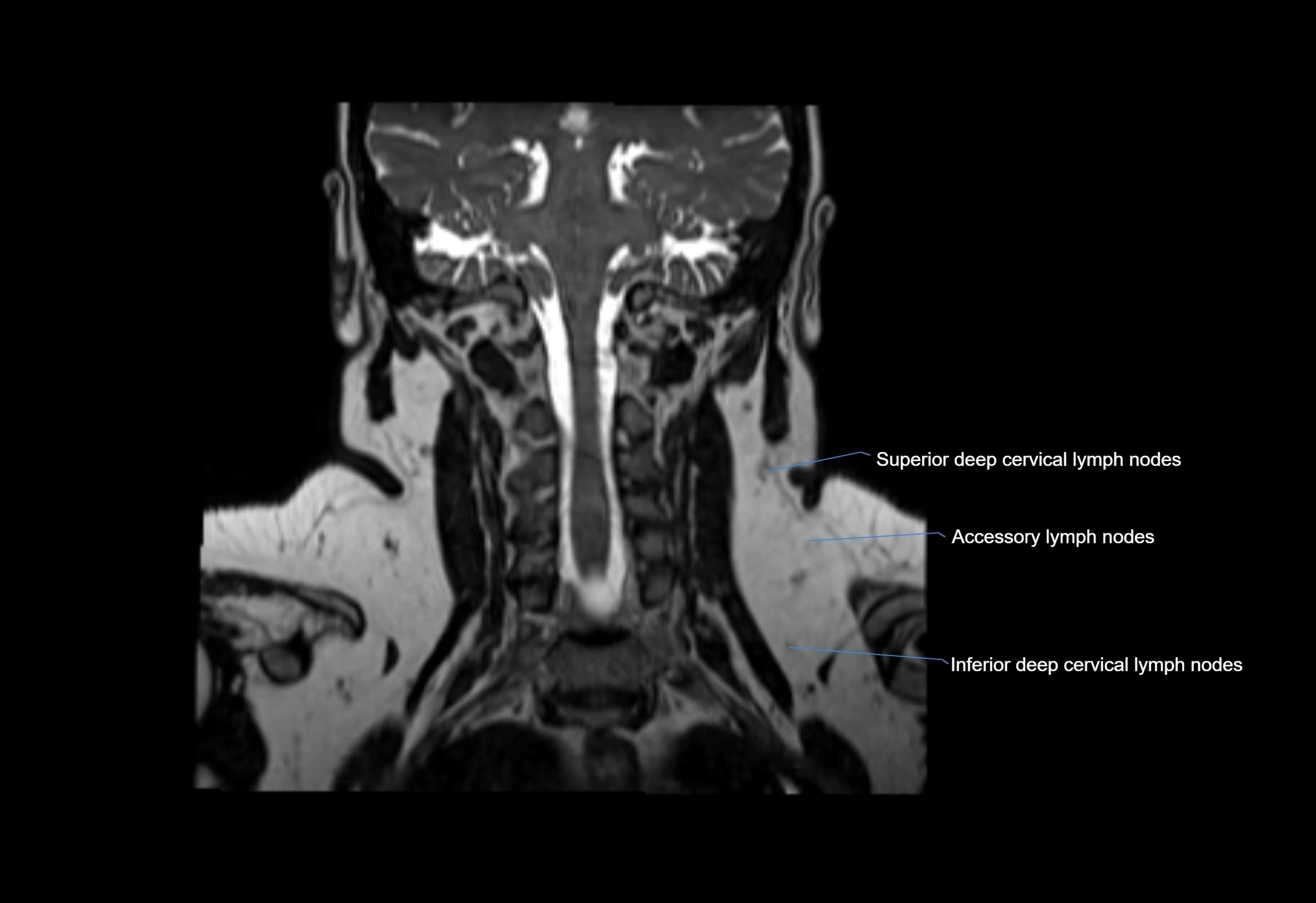 Neck coronal lymph node cross sectional MRI anatomy 3T MRI  image-img-00001-00023.webp